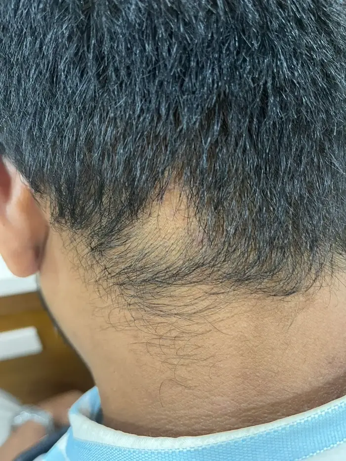 Alopecia Areata Before